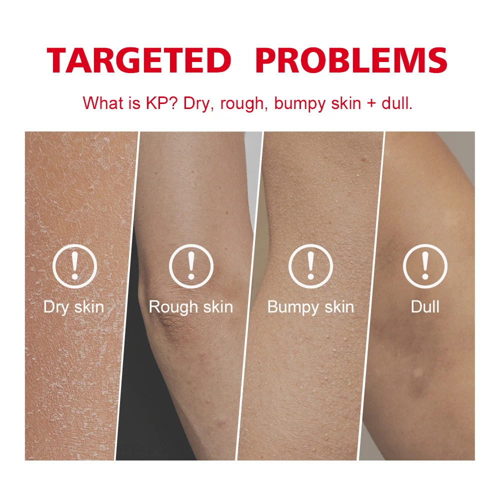 KP Bump Eradicator Body Scrub with 10% AHA for Smoothing Skin and Dual Exfoliation 28.3g 5 lakerain kp bump eradicator body scrub lak wsjz3gvc desc 5